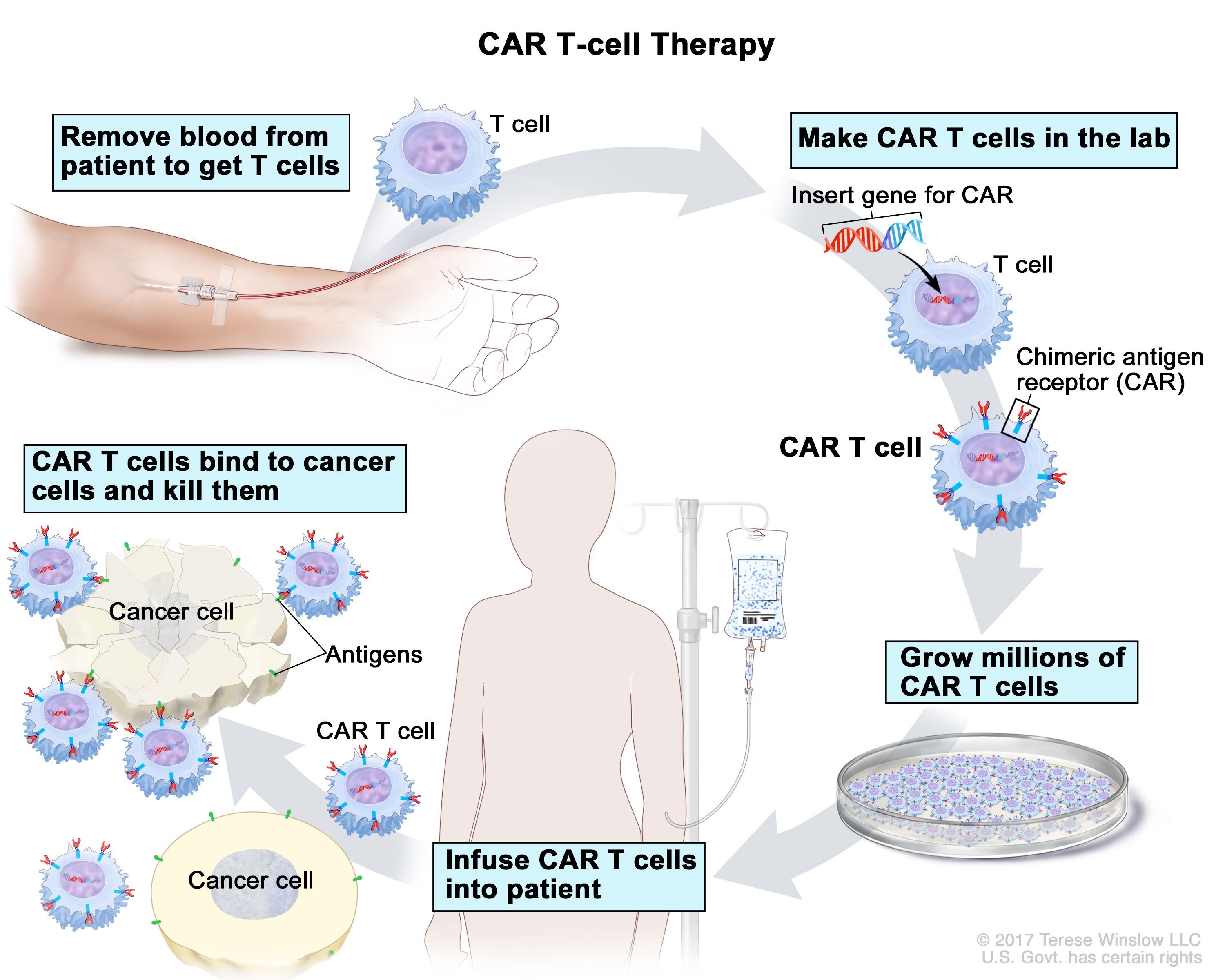 car-t cells - nci-media-cancer.gov-avalon-b2i